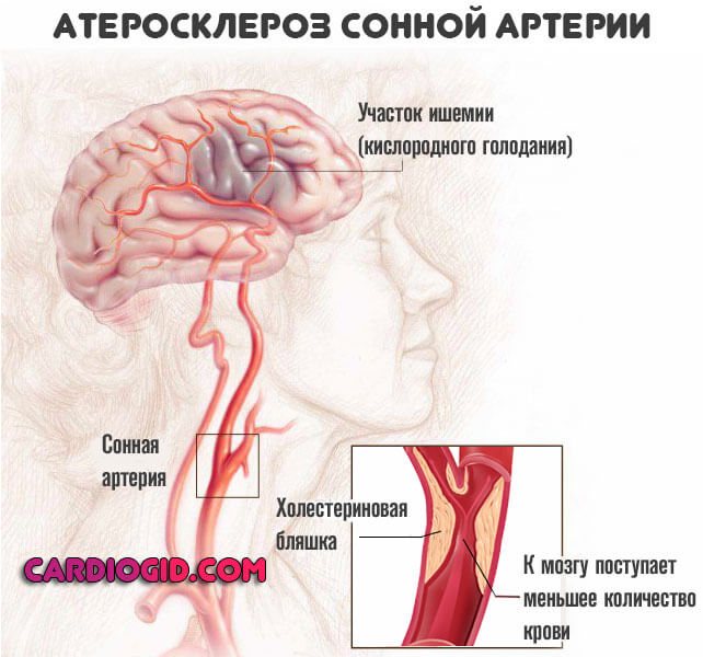 ateroskleroz-sonnoj-arterii4.jpg