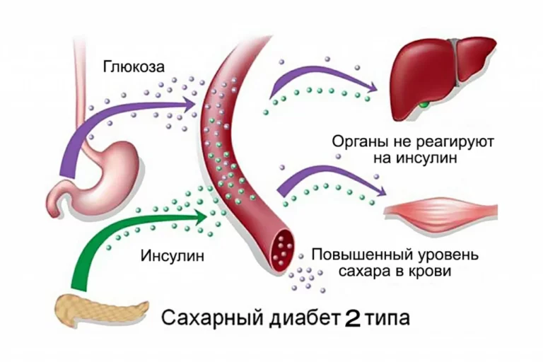 saharnyj diabet 2 tipa 768x512